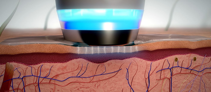 ELECTROPORACION ESTETICA