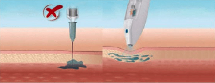 MESOTERAPIA SIN AGUJAS