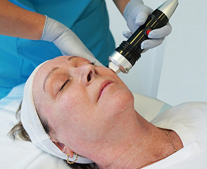 RADIOFRECUENCIA FRACCIONADA