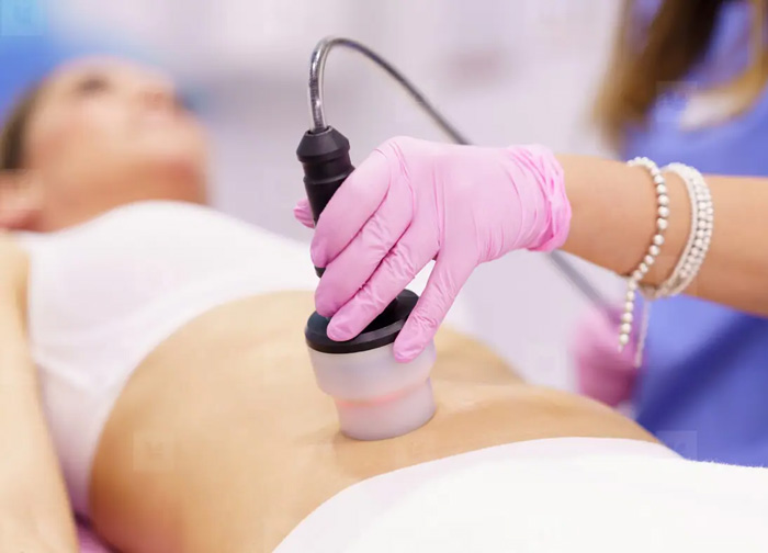 RADIOFRECUENCIA EN ESTETICA