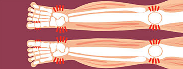 Síndrome de las piernas inquietas (RLS): un impulso incontrolable