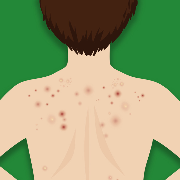 ACNE EN LA ESPALDA