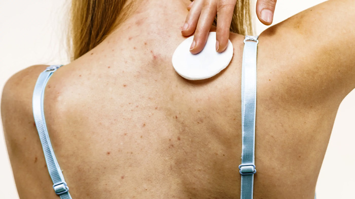ACNE EN LA ESPALDA