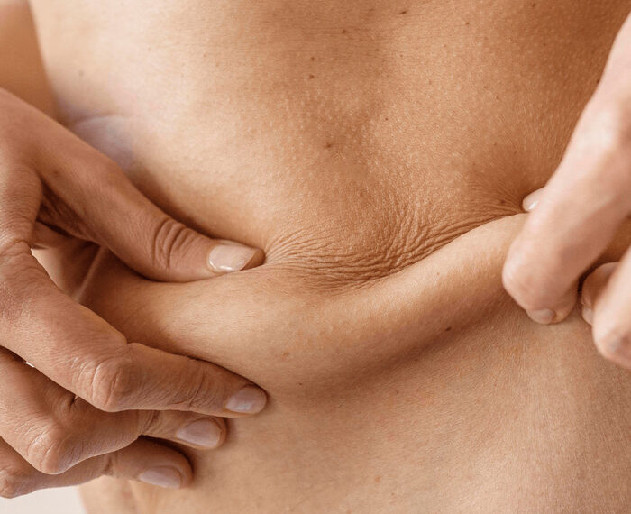 Tratamiento de lipodisolución con fosfatidilcolina para eliminar la adiposidad localizada