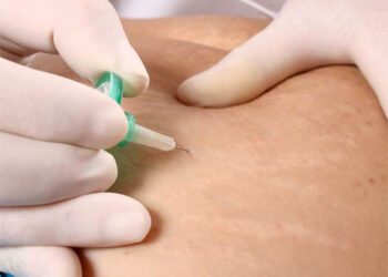 Carboxiterapia y celulitis