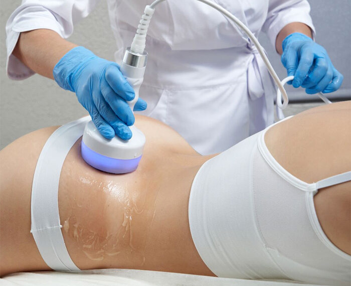 Termolipólisis: una combinación de tecnologías para reducir grasa corporal