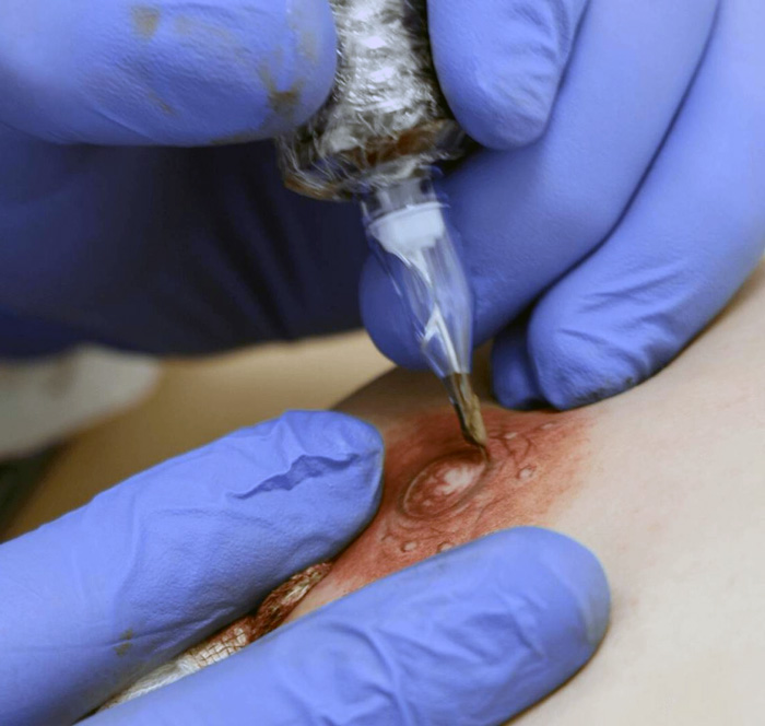 Reconstruccion de la areola mamaria