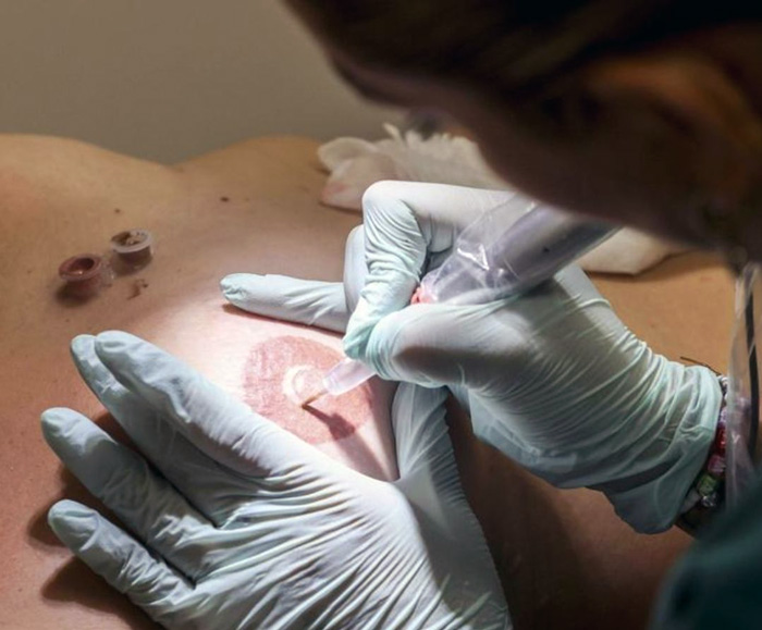 Reconstruccion de la areola mamaria