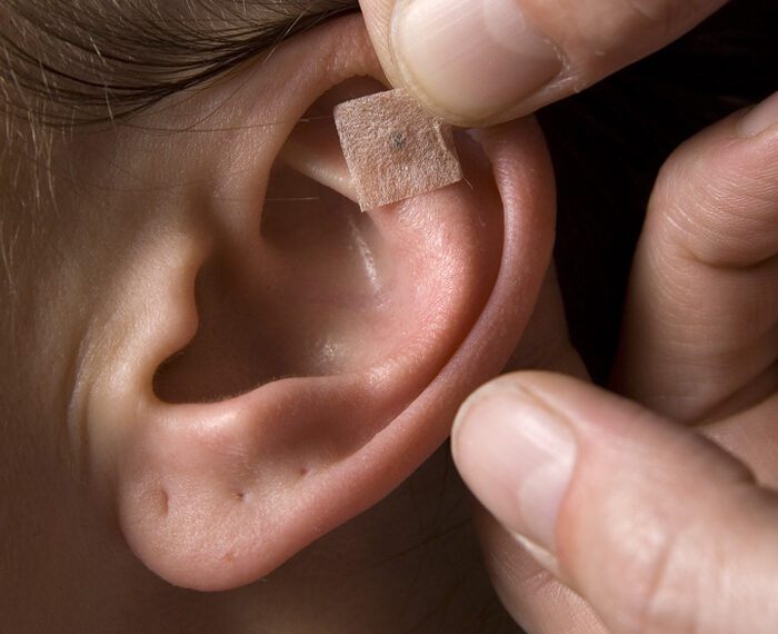 Auriculoterapia