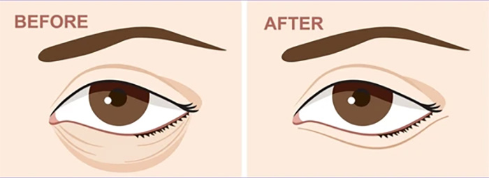 BLEFAROPLASTIA