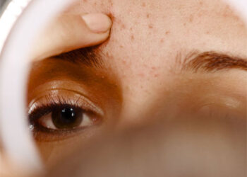 Acné, una afección milenaria que padece el 85% de la población