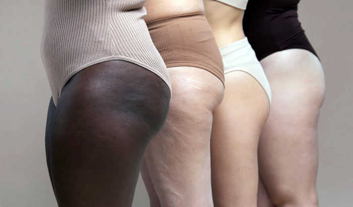 CELULITIS