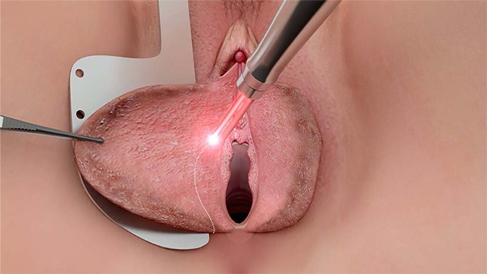 Cirugía de la intimidad