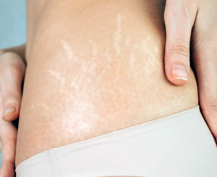 Estrías, un problema de difícil resolución