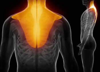 Síndrome de Dolor Miofascial y puntos gatillo