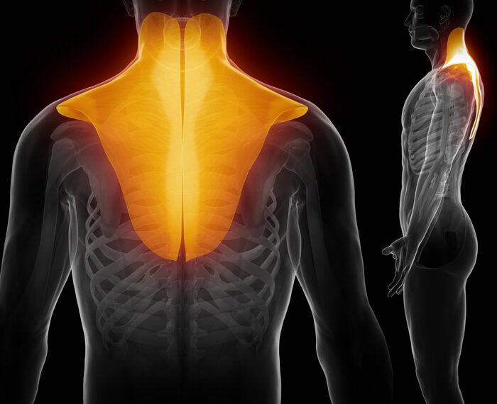 Síndrome de Dolor Miofascial y puntos gatillo