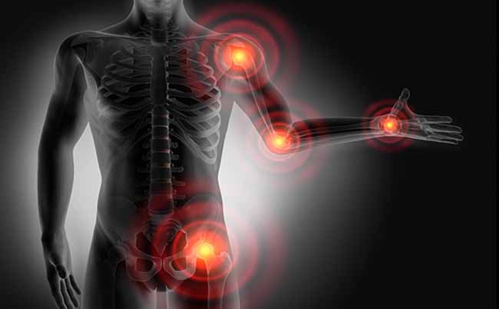 Síndrome de Dolor Miofascial y puntos gatillo