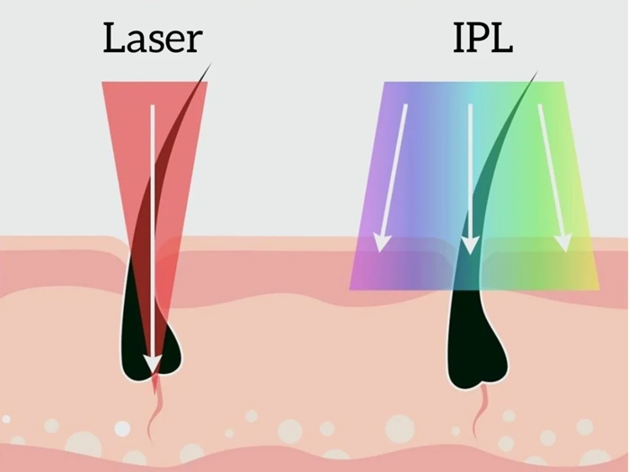 Depilación IPL: ventajas y desventajas de la luz pulsada intensa