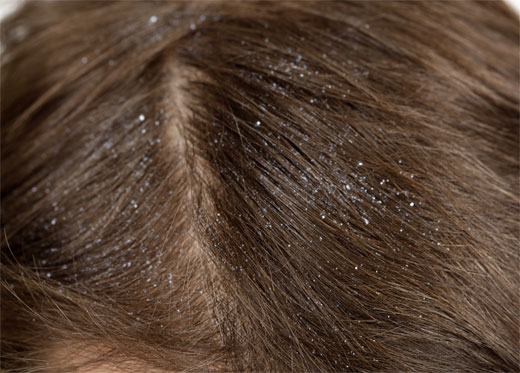 DERMATITIS SEBORREICA