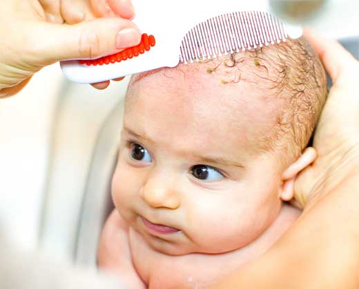 DERMATITIS SEBORREICA