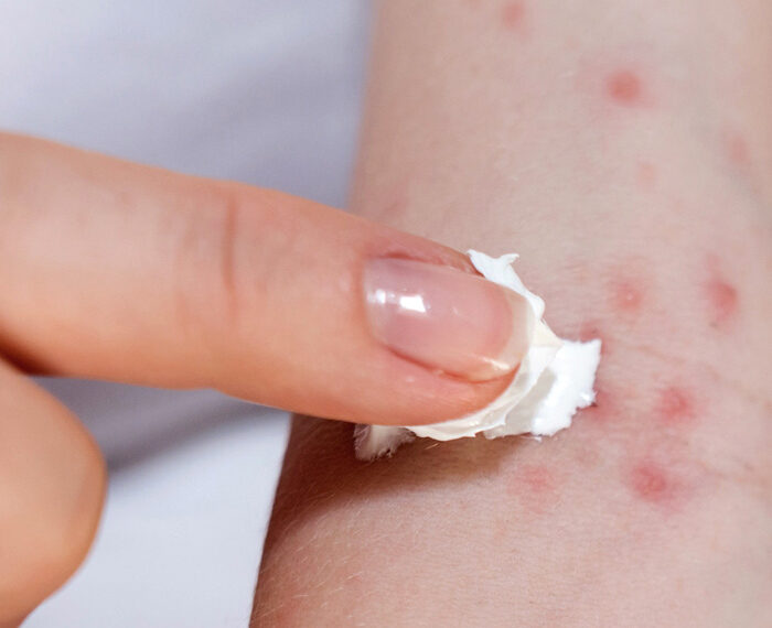 Las erupciones cutáneas