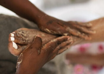EXFOLIACION DE MANOS Y PIES