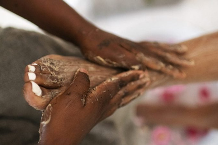 EXFOLIACION DE MANOS Y PIES