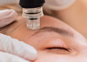 Microdermoabrasión, una combinación de exfoliación, leve succión y compresión