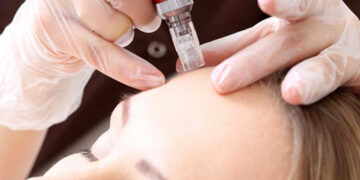 Aplicaciones y beneficios de la mesoterapia con peptonas