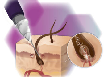 Fotodepilación: elección y planificación del tipo de tratamiento más adecuado