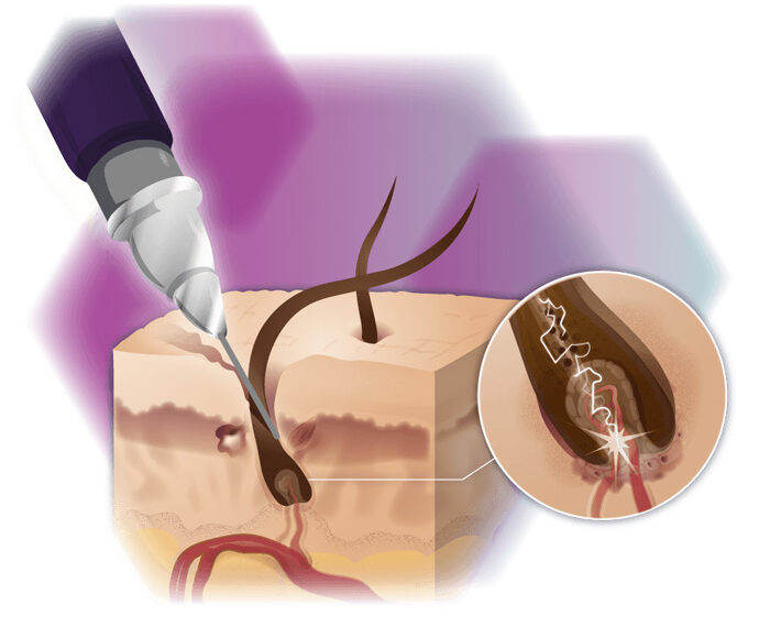 Fotodepilación: elección y planificación del tipo de tratamiento más adecuado