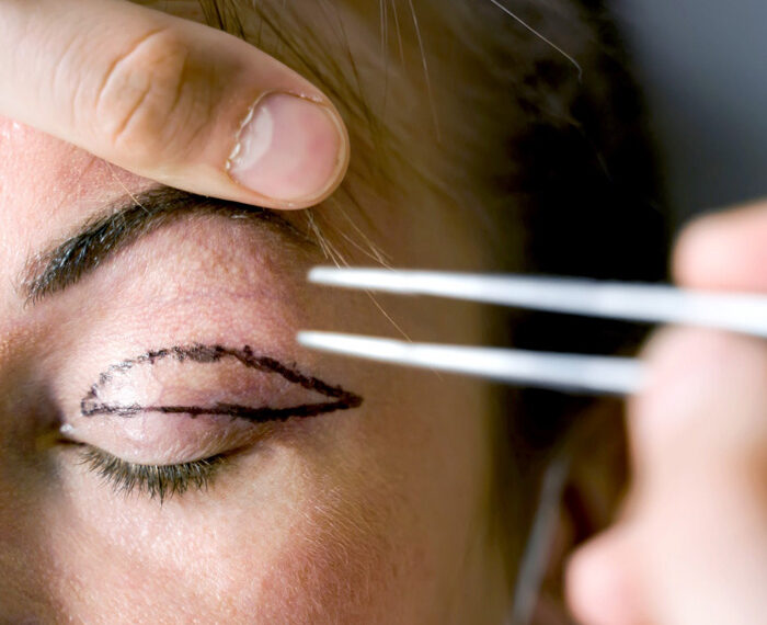 BLEFAROPLASTIA