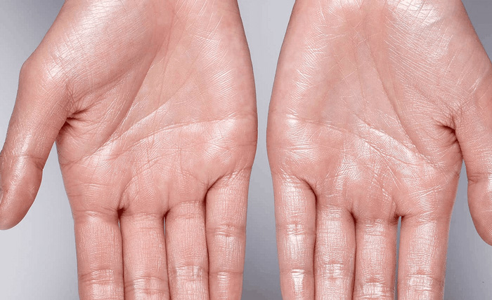 Hiperhidrosis: sudoración excesiva