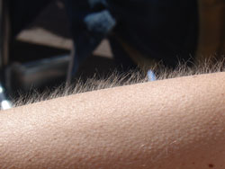 Piel ancerina o “piel de pollo”: tratamiento corporal de renovación celular