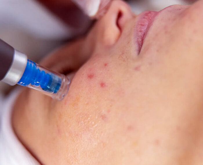 Alteraciones de la pigmentación de la piel