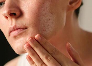 Acné después de los 40 años