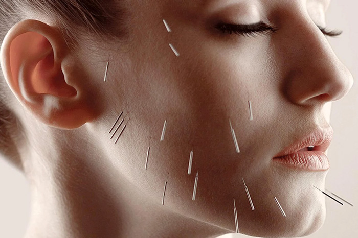 ACUPUNTURA COSMETICA