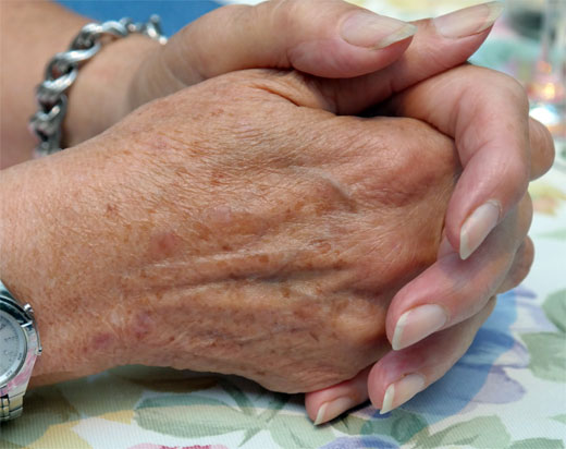 Léntigos seniles, solares, benignos y malignos