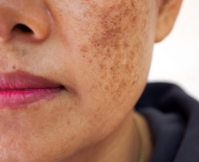 MELASMA Y LENTIGO