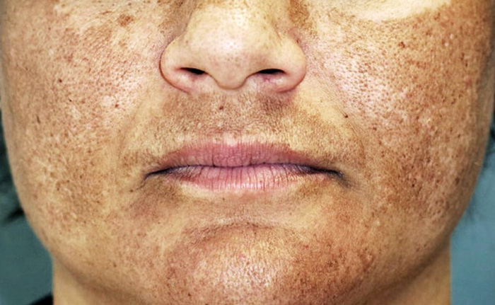 MELASMA Y LENTIGO