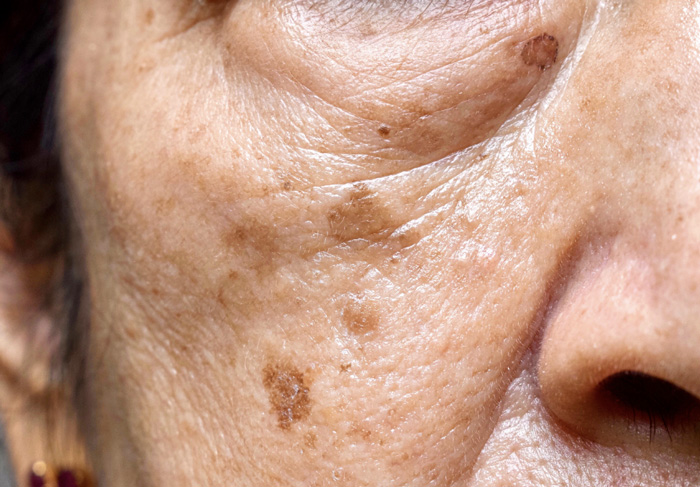 MELASMA Y LENTIGO