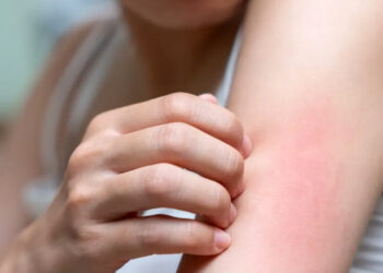 Prurito, el deseo de rascarse