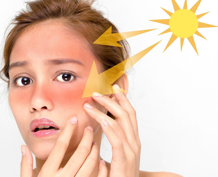 Efectos biológicos de la radiación UV sobre la piel