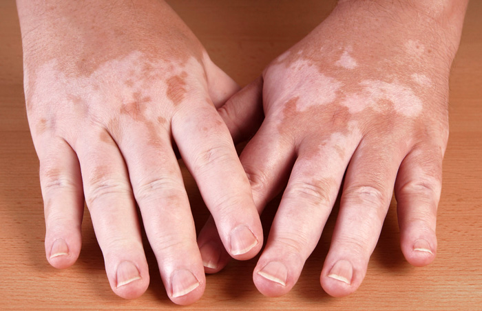 VITILIGO