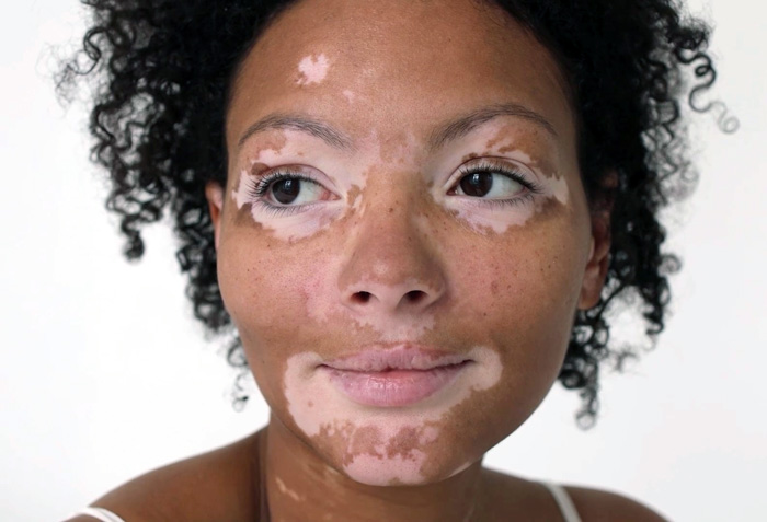 VITILIGO