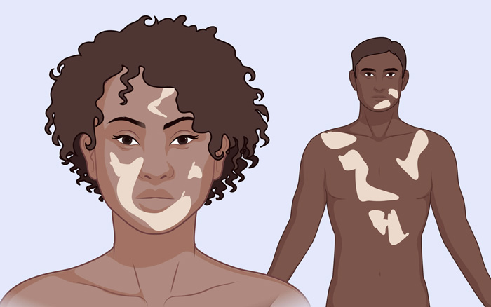 VITILIGO
