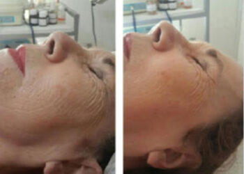 Fotoenvejecimiento: propuesta de tratamiento