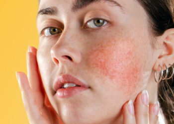 La rosácea, una afección que padecen 40 millones de personas en todo el mundo