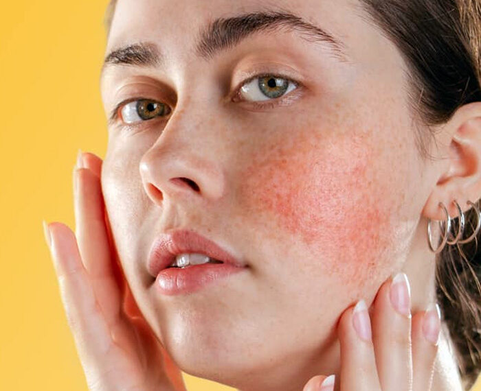 La rosácea, una afección que padecen 40 millones de personas en todo el mundo