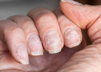 Uñas: siete signos reveladores de trastornos en la salud